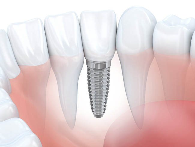 Implantat - Zahn - Zahnarzt in 58300 Wetter (Ruhr)